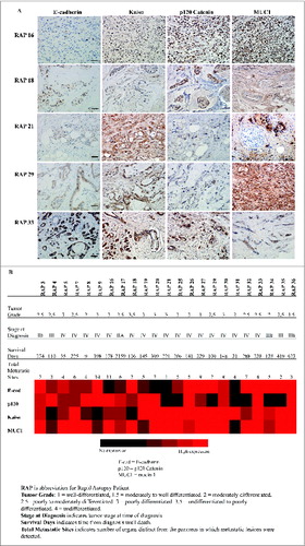 Figure 1. Immunohistochemistry analysis of E-cadherin, p120 catenin, Kaiso and MUC1 in patient samples with metastatic pancreatic cancer. (A) Representative immunohistochemical images of primary pancreatic tumor tissue from patients with metastatic pancreatic cancer, stained for E-cadherin, p120 catenin, Kaiso, and MUC1. Scale bar, 5 μm. (B) Heat map shows the relative expression levels of each antigen analyzed in samples from 23 rapid autopsies of individual patients as detected by immunohistochemistry, with relative expression levels indicated as described previously.Citation25 Patient samples are annotated for tumor grade, stage and survival post-diagnosis.