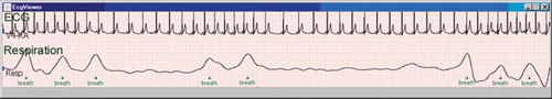Figure 2. ECG and respiration in sleep apnea. Example of ECG (top) and respiration signal (bottom) for episodes of apnea.