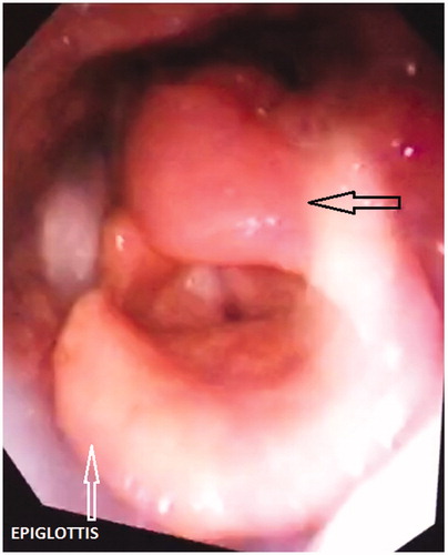 Figure 1. Endoscopic view showing swollen left arytenoid (black arrow).