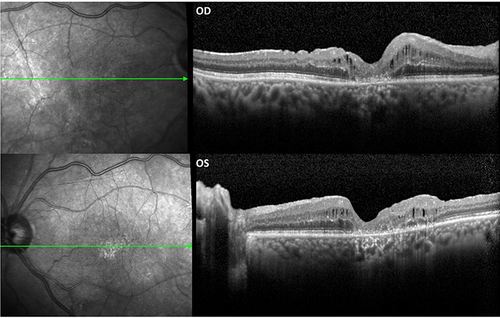 Figure 3 Optimal coherence tomography (OCT) scan of the right and left eye (OD and OS, respectively) of patient 4 (see Table 3), showing outer retina atrophy in the foveal area and some intraretinal fluid, after a bilateral subretinal haemorrhage.