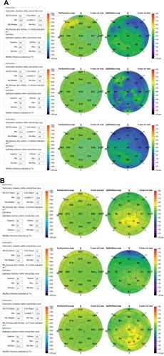 Figure 5 Anterior-segment OCT imaging pachymetry maps for cornea (left) and corneal epithelium (right) covering the center 6 mm diameter area.