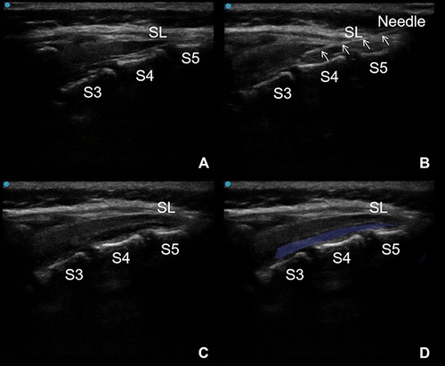 Figure 1 Procedure of ultrasound-guided continuous sacral block. (A) The ultrasound image of the sacral canal between the S3 and S5 in median sagittal plane. (B) The needle (indicated by the triangular arrow) entered the sacral canal. (C and D) The local anaesthetic spread in the sacral canal (the light blue area).