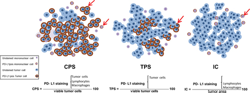 Figure 1 Combined positive score (CPS) of PD-L1 expression defined by (total number of stained tumor cells and immune cells divided by number of all viable tumor cells) × 100; tumor proportion score (TPS) of PD-L1 expression defined by percentage of stained tumor cells; immune cell (IC) PDL1 expression defined by percentage of stained immune cells. Arrows indicate PD-L1-positive cells accounted for in each scoring criterion’s calculations to describe PD-L1 expression. Reprinted from Sajjadi E, Venetis K, Scatena C, Fusco N. Biomarkers for precision immunotherapy in the metastatic setting: hope or reality? Ecancermedicalscience. 2020;14. Creative Commons.Citation7