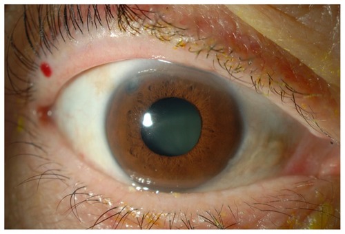 Figure 1 Anterior segment of right eye at initial visit in case 1.