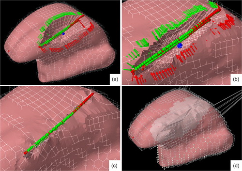 Figure 6. A visual representation of the suturing procedure using the surgical tool. (a–b): The red and green point forces (arrows) will move to their targets points (bullets) on an invisible plane located on the longest axial direction of the resection. (c): The pairs of points on the edges that were closest to each other were bounded by a virtual knot. (d): Post-operative mesh using a new generated FE mesh. The lighter area is marked as fibrosis in this particular case.