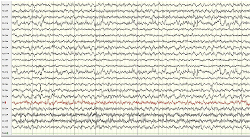 Figure 8. EEG on day #2 after using felbamate 2,400 mg.