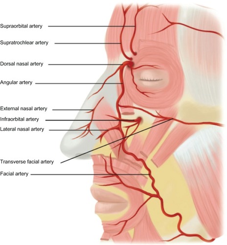 Figure 11 Facial artery anatomy illustrating the most common sites of vascular occlusion.