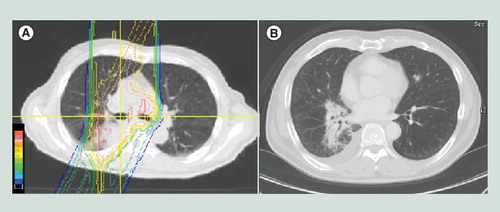 Figure 3. Dose distribution (A) and a CT image 1 year after proton beam therapy (B) for stage IIIB non-small-cell lung cancer.The doses to the anterior lung and esophagus were decreased, and fibrosis was limited in the posterior lung.