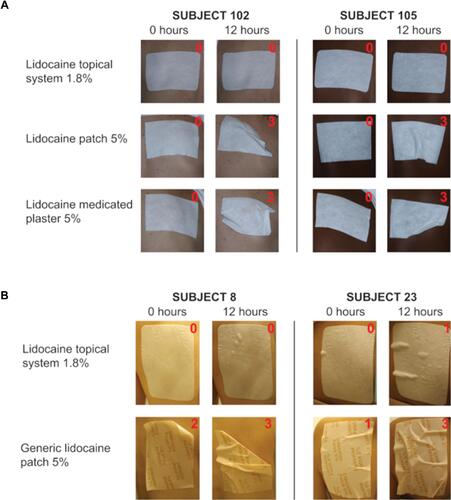 Figure 3 Representative adhesion performance with the FDA score (denoted in red) in Studies 2 and 3. Subjects were treated with the lidocaine topical system 1.8% (top rows in panels A and B), lidocaine patch 5% (middle row in A), lidocaine medicated plaster 5% (bottom row in A), or generic lidocaine patch 5% (bottom row in B). Photographs were taken immediately following product application (0 hours) and at the end of the study after 12 hours (±15 minutes) of wear.