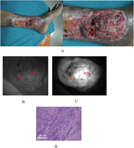 Figure 2 Preoperative ICG fluorescence imaging of a scar cancer of left medial malleolus. (A) The gross appearance; (B) Visible light image under near-infrared imaging; (C) Fluorescence image under preoperative imaging. Red arrows indicate tissues with strong fluorescence signals; (D) The HE staining of the biopsied tumor tissues. The scale bar indicates 100 μm.