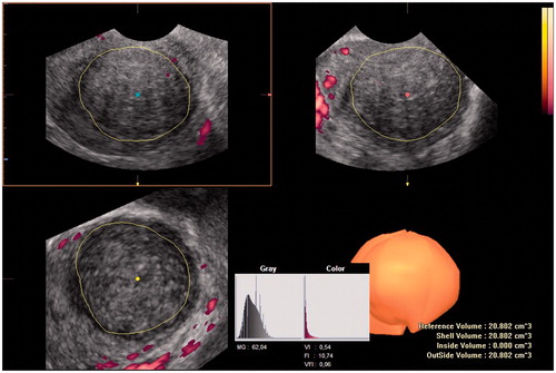 Figure 3. 3D power Doppler image in VOCAL: oval fibroid with vascular capsule, good peripheral penetration.