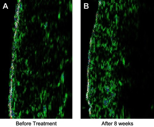 Figure 5 High-frequency ultrasound pictures of treated area at (A) baseline and (B) 8 weeks after treatment.