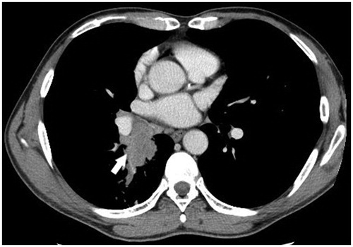 Figure 1. Thoracic CT scan image at the time of diagnosing SqCLC. Contrast-enhanced CT image with soft-tissue window showing a centrally located mass in the right lung with mediastinal invasion (arrow), and mediastinal lymphadenopathy.