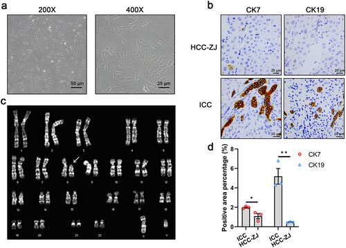 Figure 1. The morphology of HCC-ZJ cells (a); immunohistochemistry for CK7 and CK19 (b); the karyotype of HCC-ZJ cells (c); the CK7 and CK19 positive rate of HCC-ZJ and intrahepatic cholangiocarcinoma (ICC) samples (n = 3) (d). * represents P < 0.05 and ** represents P < 0.01.