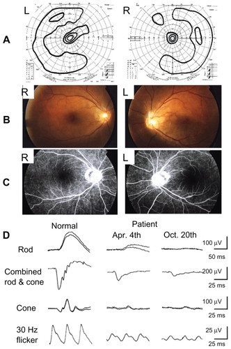 Figure 1 Ophthalmologic findings in a case of paraneoplastic retinopathy. A) Visual field obtained by Goldmann perimetry showing ring scotomas in both eyes. B) Fundus photographs of our patient. C) Fluorescein angiograms of our patient. D) Results of full-field ERGs. The ERG amplitudes of both the rod and cone components are reduced and were smaller at the six-month followup examination.
