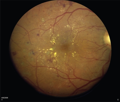 Figure 2a Color photograph of a macula exhibiting diabetic macular edema. Microaneurysms and intra-retinal hemorrhages are visible as red spots. Retinal thickening is visible as a loss of granularity combined with subtle changes in coloration and is best visualized in stereo using slit lamp biomicroscopy. Lipid exudates are visible as yellow streaks or spots, often distributed in a circinate pattern around leaking microaneurysms.