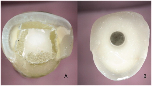 Figure 4. Cross sections of teeth with individually formed FRC post (A) and prefabricated FRC post (B). In the individually formed FRC post system the reinforcing fibers are located closer to the highest stress are of tooth, i.e. surface of the root and the fibers provides better support for the crown than the prefabricated post.
