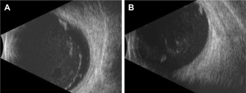 Figure 1 B-scan ultrasound images of a definite retinal tear.