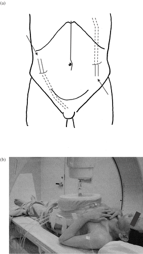 Figure 1. (a) Two infusion catheters that were placed beneath the hemidiaphragma and in the Douglas pouch for infusion and drainage. (b) Thermotron RF-8, 8 MHz radiofrequency (RF) capacitive heating equipment. In general, two opposing 25 cm diameter electrodes were selected for heating. To prevent surface burning, a cooling pad was used during hyperthermia through which 0.9% saline cooled to 5°C was circulated.