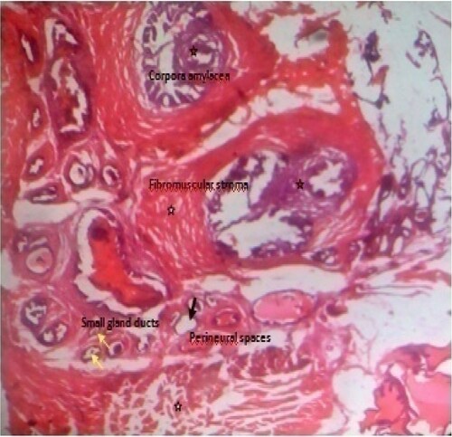 Figure 7. Photomicrograph of prostate tissue section of a rat from group 7 (BPH-induced and treated with 400 mg/kg of MF) showing hyperplasia of prostrate ducts with intact fibromuscularstroma (star) together with invasion of intraprostatic perineural spaces (black arrow). There is concretions especially corpora amylacea. The gland pattern appears small with loss of columnar or cubiodal cells (yellow arrow) H&E. mag. 400X.