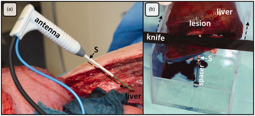 Figure 1. (a) Open ablation via laparotomy along the right costal arch. A plastic sleeve (S), placed over the antenna (A) shaft, was used to mark the ablation. After MWA, the plastic sleeve was advanced (dashed arrow) into the liver tissue (L) exactly to the center of the ablation. (b) Ablations were cut at the tip and perpendicular to the plastic sleeve (S) with the help of a custom-made aiming device. This experimental setting ensured an exact and reproducible evaluation of ablations.