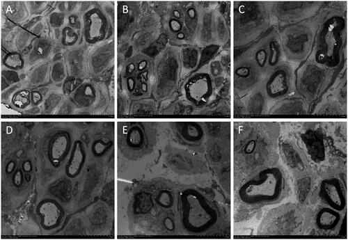 Figure 8. Electron micrograph of myelin sheath and axons in the musculocutaneous nerve near the nerve entry point 6 weeks after surgery in the control group (A), blank hydrogel group (B), 5 mg/mL quercetin-loaded hydrogel group (C), 10 mg/mL quercetin-loaded hydrogel group (D), 50 mg/mL quercetin-loaded hydrogel group (E), and 100 mg/mL quercetin-loaded hydrogel group (F).