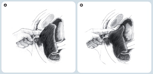 Figure 5. Digital palpation of the puborectalis muscle insertion.(A) Shows a normal muscle, (B) an avulsion injury.Reproduced with permission from Citation[20].