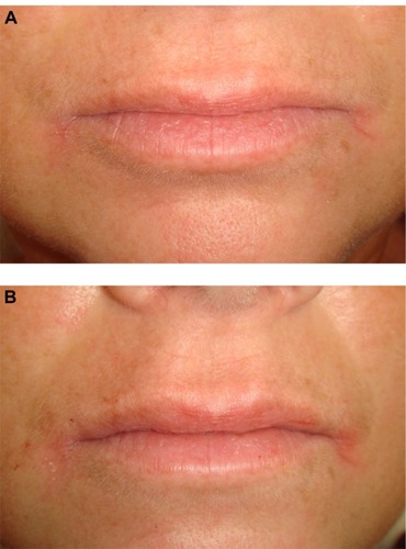 Figure 3 A 45-year-old woman with thin lips and flat philtrum.