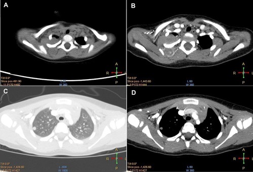 Figure 1 Preoperative image. (A) Axial unenhanced CT scan revealed a large posterior mediastinal mass. (B) The lesion was uneven enhanced. (C and D) There was another nodular soft tissue located in the right lung.Abbreviation: CT, computed tomography.