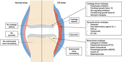 Figure 1 Active drugs related to the three main molecular or mechanistic OA endotypes (phase 2 and 3).