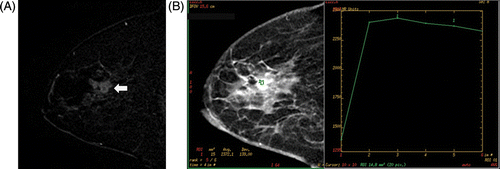 Figure 5. Partial ablation in a 60-year-old woman (patient 5 mentioned in Table II). (A) A central dark signal intensity and a nodular or irregular thick enhancement (arrow) was observed on the early subtraction image of MRI post HIFU. (B) Kinetic curve pattern showed early rapid enhancement and delayed washout pattern.