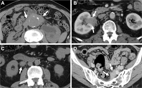 Figure 1 Typical computed tomography findings in idiopathic RPF. (A) Periaortic lesion (arrow) with aneurysmal change of the affected abdominal aorta and left hydronephrosis. (B) Right renal pelvic mass (arrow). (C) Right periureteral mass (arrow). (D) Placoid lesion (arrow) in the pelvis.