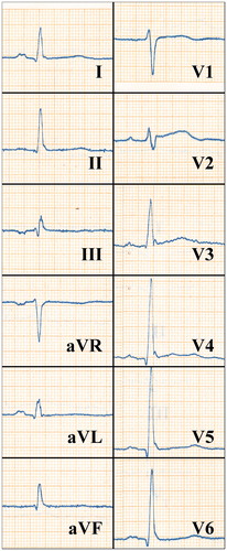 Figure 2. An ECG of a 41-year-old male who hadn’t been diagnosed with cardiac disease showing an ER pattern in the inferior and lateral leads. The subject died of SCD after 25 years of follow-up. The paper speed is 50 mm/s.