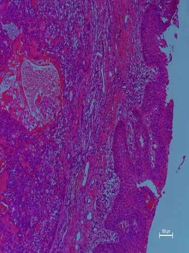 Figure 4 Microscopic examination revealed that the respiratory lining epithelium and subepithelium contained a mixed tumor. The neoplasm showed epithelial, myoepithelial, and mesenchymal components containing mucoid, myxoid, and chondroid areas (hematoxylin and eosin, 40).