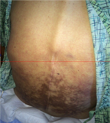 Fig. 1 Erythema ab igne occuring over the lower back resulting from repeated heating pad use (Citation2).