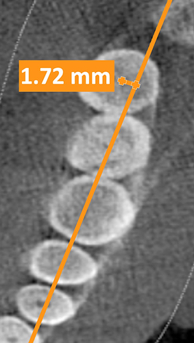 Figure 5 Lower third molar horizontal position, showing a lingually positioned third molar.