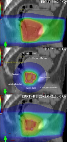 Figure 1. Absorbed dose distributions of 50 Gy external beam radiation therapy (EBRT, top panel), 20 Gy brachytherapy (BT, mid panel) and 70 Gy EBRT+ BT (bottom panel). In the colour wash, red corresponds to 100%, green to 50%, and blue to 25% of the prescribed dose, respectively (colour in online version only).