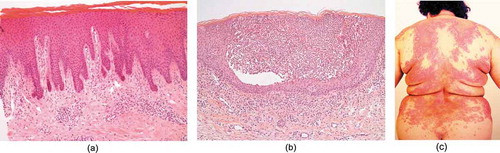 Figure 1. Microscopic and macroscopic features of GPP. Histopathology of psoriasis. (a) Psoriasis vulgaris characteristically shows acanthosis, parakeratosis, and dermal inflammatory infiltrates. (b) In pustular psoriasis, acanthotic changes are accompanied by epidermal predominantly neutrophilic infiltrates, which cause pustule formation. (Reproduced from “Psoriasis Pathogenesis and Treatment” by Adriana Rendon and Knut Schäkel [Int. J. Mol. Sci. 2019; 20: 1475; http://dx.doi.org/10.3390/ijms20061475] licensed under CC-BY 4.0). (c) Macroscopic features of GPP. (Reproduced with permission from DermNet New Zealand Trust, Hamilton, New Zealand). GPP: generalized pustular psoriasis