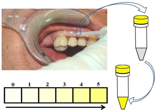 Figure 1 Semi-quantitative analysis procedure to determine the presence of VSC. Color changes indicating higher concentration of sulfhydryls.