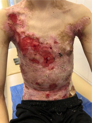 Figure 2 Appearance of lesions on the patient’s chest and abdomen on presentation.