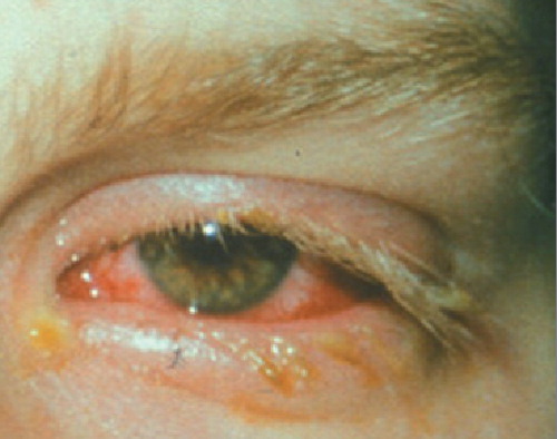 Figure 5. Severe eye involvement in erythema multiforme majus, Stevens–Johnson syndrome and toxic epidermal necrolysis.
