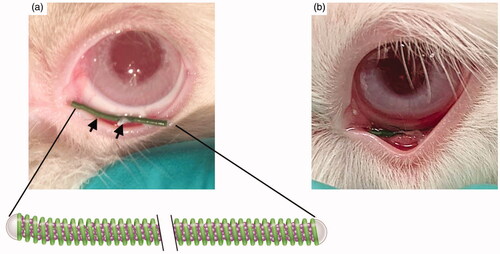Figure 1. (a) Location of the ocular coil in the conjunctival fornix during the stitching procedure. The arrows indicate two of the three stitches. The magnification below shows a representation of the ocular coil and its microsphere filling. (b) Location of the ocular coil in the conjunctival inferior fornix during normal wear.