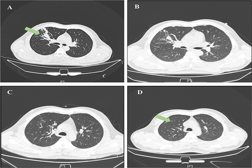 Figure 3 Chest CT imaging changes of the patient. (A) The imaging result on February 9 shows inflammation in the upper lobe of the right lung. The arrow indicates the site of infection. (B) The imaging result was on February 16. (C) The imaging result after 13 days after treatment (February 24). (D) The imaging result after treatment (March 7) suggests that inflammation was obviously relieved. The arrow shows that the pneumonia was resolved.
