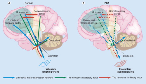 Figure 1. Proposed brain circuitry involved in emotional expression, and its hypothesized dysfunction in pseudobulbar affect (PBA).Normally (A), an emotional motor expression network including cortico–ponto–cerebellar afferentation (upper blue arrows) enables the cerebellum to act as a ‘gate-control’ for the motor expression of emotion (lower blue arrows). Inputs to this network (green and red arrows) include an inhibitory influence from sensory cortices. In PBA (B), reduced inhibitory influence at the cortical level (broken red cortical arrows) results in increased aberrant activation within the network (broken blue arrows), giving rise to the motor manifestations of pathological laughing/crying.