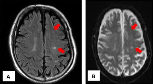 Figure 2 Magnetic resonance imaging of the head (A) fluid-attenuated inversion-recovery images, (B) diffusion-weighted images. Hyperintense areas, mainly in the parietal lobe, are sporadically observed (red arrow) and were considered septic cerebral embolisms.