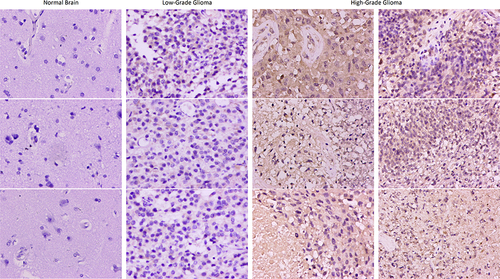 Figure 11 Immumohistochemical staining for FCGBP expression in normal brain, low-grade glioma and high-grade glioma tissues. Magnification, ×200.