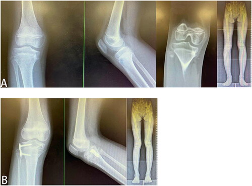 Figure 3. (A) The medial focus of the tibia. X-ray, CT, and full-length radiography of the lower limb showed varus of the right knee; (B) Bone bridge resection combined with lateral figure-of-eight plate epiphyseal block. Two years after surgery, the bone bridge was removed entirely without iatrogenic epiphyseal injury. Full-length radiography of the lower limbs showed that the right lower limb’s gravity line returned to normal.