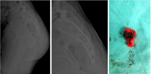 Figure 2 Partial excision postoperative images and excised coccygeal segment.