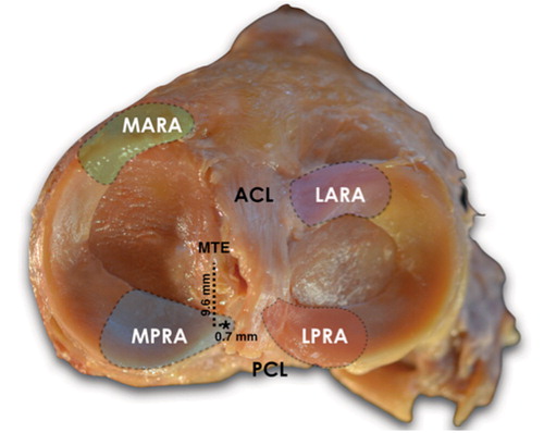Figure 2. Cadaveric image (superior view) demonstrating the anatomical landmarks to identify a medial meniscus posterior root attachment (asterisk) in a right knee. MTE: medial tibial eminence; MARA: medial meniscus anterior root attachment; LARA: lateral meniscus anterior root attachment; MPRA: medial meniscus posterior root attachment; LPRA: lateral meniscus posterior root attachment.