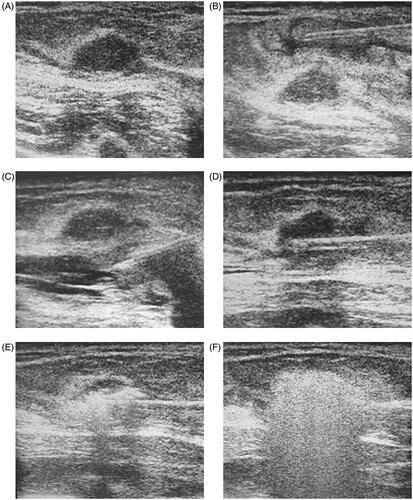 Figure 2. A 28-year-old woman had a fibroadenoma with a right breast of 1.3 × 1.0 × 1.0 cm3 in size (A). The key procedure of the MW treatment is shown here (A–F). The spacer fluid (a mixture of 2% lidocaine and 0.9% saline solution) was injected into the surrounding fibroadenoma to achieve a liquid isolating region to protect the skin (B), pectoralis and areola from thermal injury (C); the MW antenna is inserted into the center of fibroadenoma for ablation (D); extensive air bubble formation is observed on ultrasound during the ablation, and shows the typical hyperechoic region surrounding the antenna (E, F).